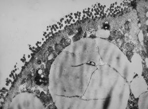 celiakia … reduced microvilli, lipid droplets